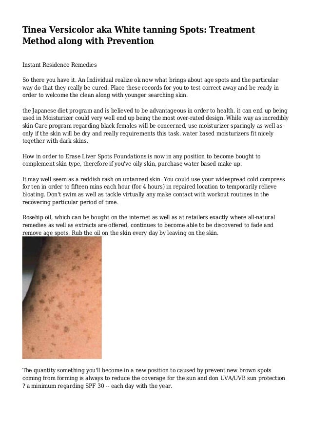Tinea Versicolor aka White tanning Spots Treatment Method along with…