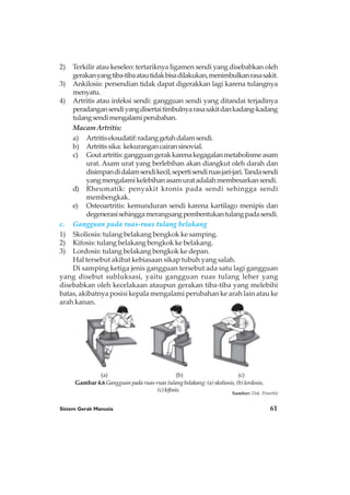 Sistem Gerak Manusia 61
Gambar 4.6 Gangguan pada ruas-ruas tulang belakang: (a) skoliosis, (b) lordosis,
(c) kifosis.
Sumber: Dok. Penerbit
(a) (b) (c)
2) Terkilir atau keseleo: tertariknya ligamen sendi yang disebabkan oleh
gerakanyangtiba-tibaatautidakbisadilakukan,menimbulkanrasasakit.
3) Ankilosis: persendian tidak dapat digerakkan lagi karena tulangnya
menyatu.
4) Artritis atau infeksi sendi: gangguan sendi yang ditandai terjadinya
peradangansendiyangdisertaitimbulnyarasasakitdankadang-kadang
tulangsendimengalamiperubahan.
MacamArtritis:
a) Artritiseksudatif:radanggetahdalamsendi.
b) Artritissika: kekurangancairansinovial.
c) Goutartritis:gangguangerakkarenakegagalanmetabolismeasam
urat. Asam urat yang berlebihan akan diangkut oleh darah dan
disimpandidalamsendikecil,sepertisendiruasjari-jari.Tandasendi
yangmengalamikelebihanasamuratadalahmembesarkansendi.
d) Rheumatik: penyakit kronis pada sendi sehingga sendi
membengkak.
e) Osteoartritis: kemunduran sendi karena kartilago menipis dan
degenerasisehinggamerangsangpembentukantulangpadasendi.
c. Gangguan pada ruas-ruas tulang belakang
1) Skoliosis: tulang belakang bengkok ke samping.
2) Kifosis: tulang belakang bengkok ke belakang.
3) Lordosis: tulang belakang bengkok ke depan.
Hal tersebut akibat kebiasaan sikap tubuh yang salah.
Di samping ketiga jenis gangguan tersebut ada satu lagi gangguan
yang disebut subluksasi, yaitu gangguan ruas tulang leher yang
disebabkan oleh kecelakaan ataupun gerakan tiba-tiba yang melebihi
batas, akibatnya posisi kepala mengalami perubahan ke arah lain atau ke
arah kanan.
 