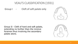Veau Classfication Advances in CBCT in cleft patients | PPTX