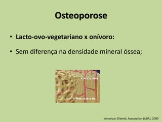 Osteoporose
• Lacto-ovo-vegetariano x onívoro:
• Sem diferença na densidade mineral óssea;
American Dietetic Association (ADA), 2009
 