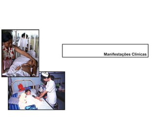 Manifestações Clínicas
 