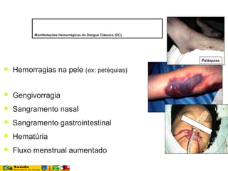  Hemorragias na pele (ex: petéquias)
 Gengivorragia
 Sangramento nasal
 Sangramento gastrointestinal
 Hematúria
 Fluxo menstrual aumentado
Petéquias
Manifestações Hemorrágicas do Dengue Clássico (DC)
 