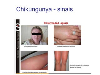 Chikungunya - sinais
 