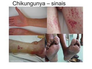 Chikungunya – sinais
 