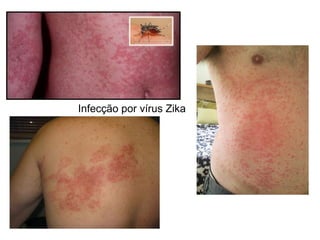 Infecção por vírus Zika
 