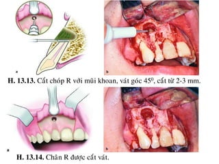 13 cat chop rang (Apicoectomy) | PDF