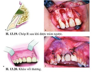 13 cat chop rang (Apicoectomy) | PDF