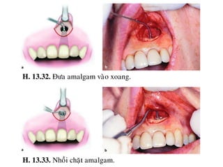 13 cat chop rang (Apicoectomy) | PDF