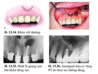 13 cat chop rang (Apicoectomy) | PDF