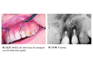 13 cat chop rang (Apicoectomy) | PDF