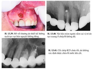 13 cat chop rang (Apicoectomy) | PDF