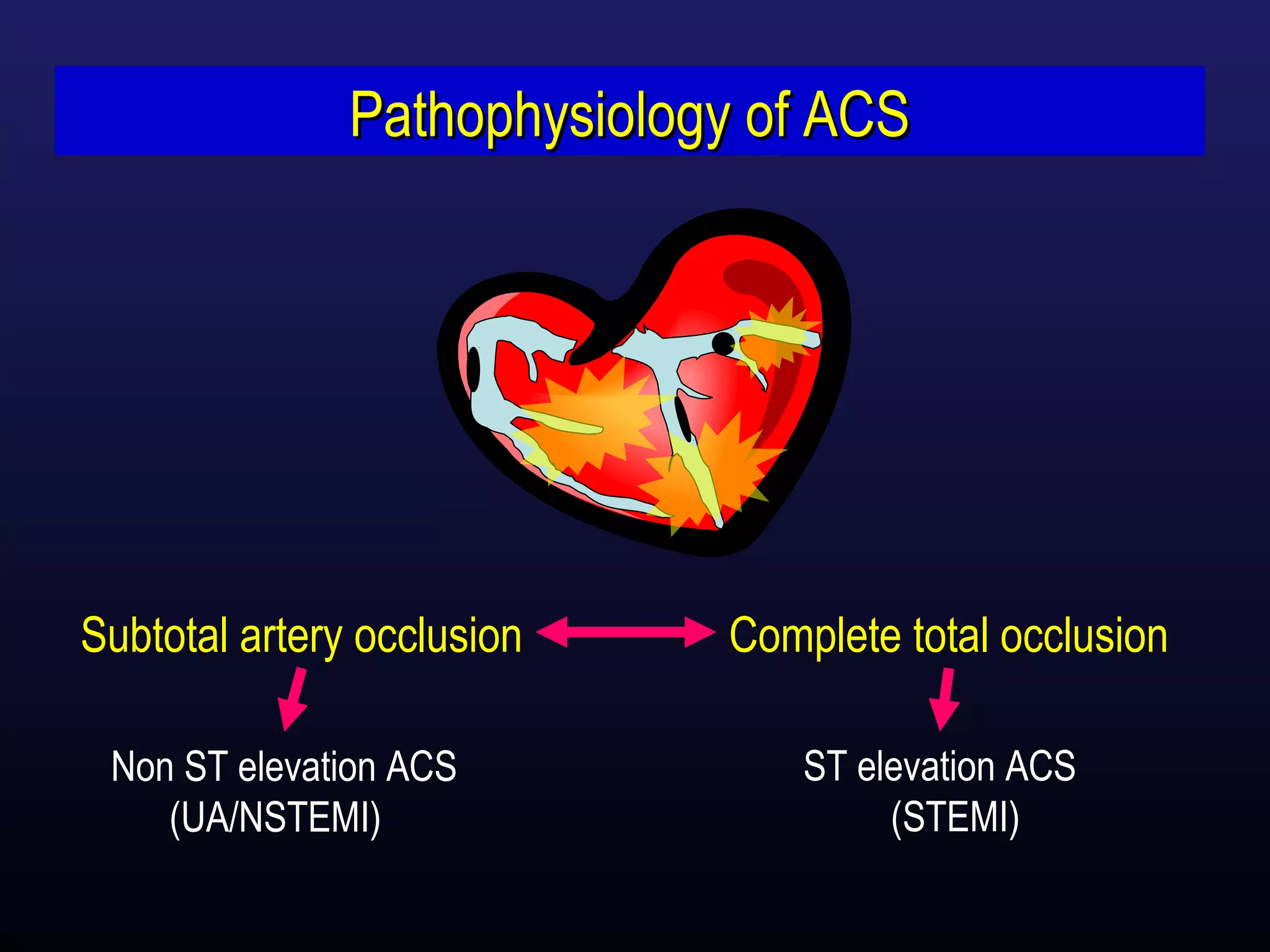 Acute Coronary Syndrome | PPT