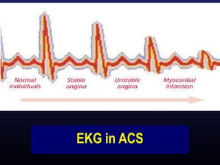 Cardiac Markers
Troponin ( T, I)

CK-MB isoenzyme

*Very specific and more sensitive

*Rises 4-6 hours after injury and

t...