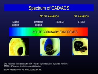 Pathophysiology of ACS

Subtotal artery occlusion
Non ST elevation ACS
(UA/NSTEMI)

Complete total occlusion
ST elevation ...
