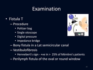 Examination
• Fistula T
– Procedure
• Politzer bag
• Siegle otoscope
• Digital pressure
• Impedance bridge
– Bony fistula in a Lat semicircular canal
– Vestibulofibrosis
• Hennebert's sign - +ve in > 25% of Ménière's patients
– Perilymph fistula of the oval or round window
29
 