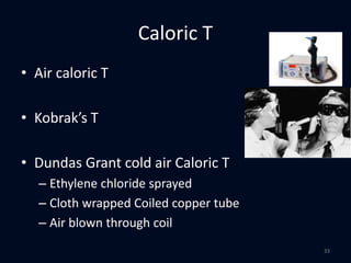 Caloric T
• Air caloric T
• Kobrak’s T
• Dundas Grant cold air Caloric T
– Ethylene chloride sprayed
– Cloth wrapped Coiled copper tube
– Air blown through coil
33
 
