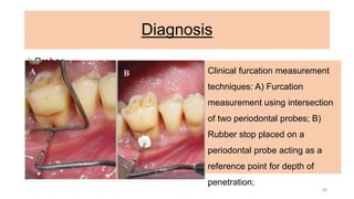 Diagnosis
Probes
I. Straight periodontal probe (a variant of which is the TPS probe)
II. automated probes, such as the Florida probe with disc attachment
III. furcation probes, such as the Nabers, ZA2, ZA3, HO2, NS2, NP2C and
ACE probes
IV. To measure the depth of furcation involvement, a straight probe, like the
UNC-15 probe with 1 mm markings, is inserted into the periodontal
pocket along the root surface to locate the initial fluting of the furcation
Clinical furcation measurement
techniques: A) Furcation
measurement using intersection
of two periodontal probes; B)
Rubber stop placed on a
periodontal probe acting as a
reference point for depth of
penetration;
26
 