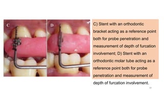 C) Stent with an orthodontic
bracket acting as a reference point
both for probe penetration and
measurement of depth of furcation
involvement; D) Stent with an
orthodontic molar tube acting as a
reference point both for probe
penetration and measurement of
depth of furcation involvement.
28
 