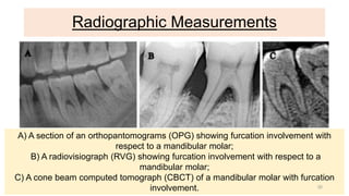 Radiographic Measurements
A) A section of an orthopantomograms (OPG) showing furcation involvement with
respect to a mandibular molar;
B) A radiovisiograph (RVG) showing furcation involvement with respect to a
mandibular molar;
C) A cone beam computed tomograph (CBCT) of a mandibular molar with furcation
involvement. 30
 