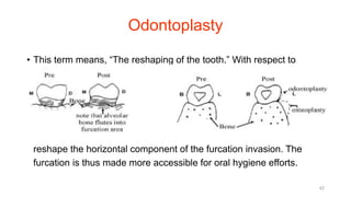 Odontoplasty
• This term means, “The reshaping of the tooth.” With respect to
furcation invasions, it means the widening of the furcal area in a
buccolingual or mesiodistal as well as apicocoronal direction with a
high-speed diamond.
• The net effect is to widen the inter-radicular area and to remove or
reshape the horizontal component of the furcation invasion. The
furcation is thus made more accessible for oral hygiene efforts.
42
 
