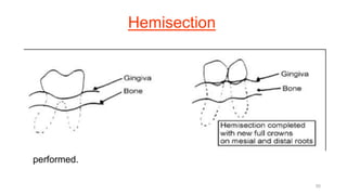 Hemisection
• In a hemisection the tooth is cut in half. The technique is used
virtually exclusively on mandibular molars to treat Class II or III
furcation invasions.
• The tooth is sectioned from buccal to lingual, parallel to a line joining
the buccal and lingual furcas. In contrast to root amputations,
extraction of one of the sections does not necessarily need to be
performed.
50
 