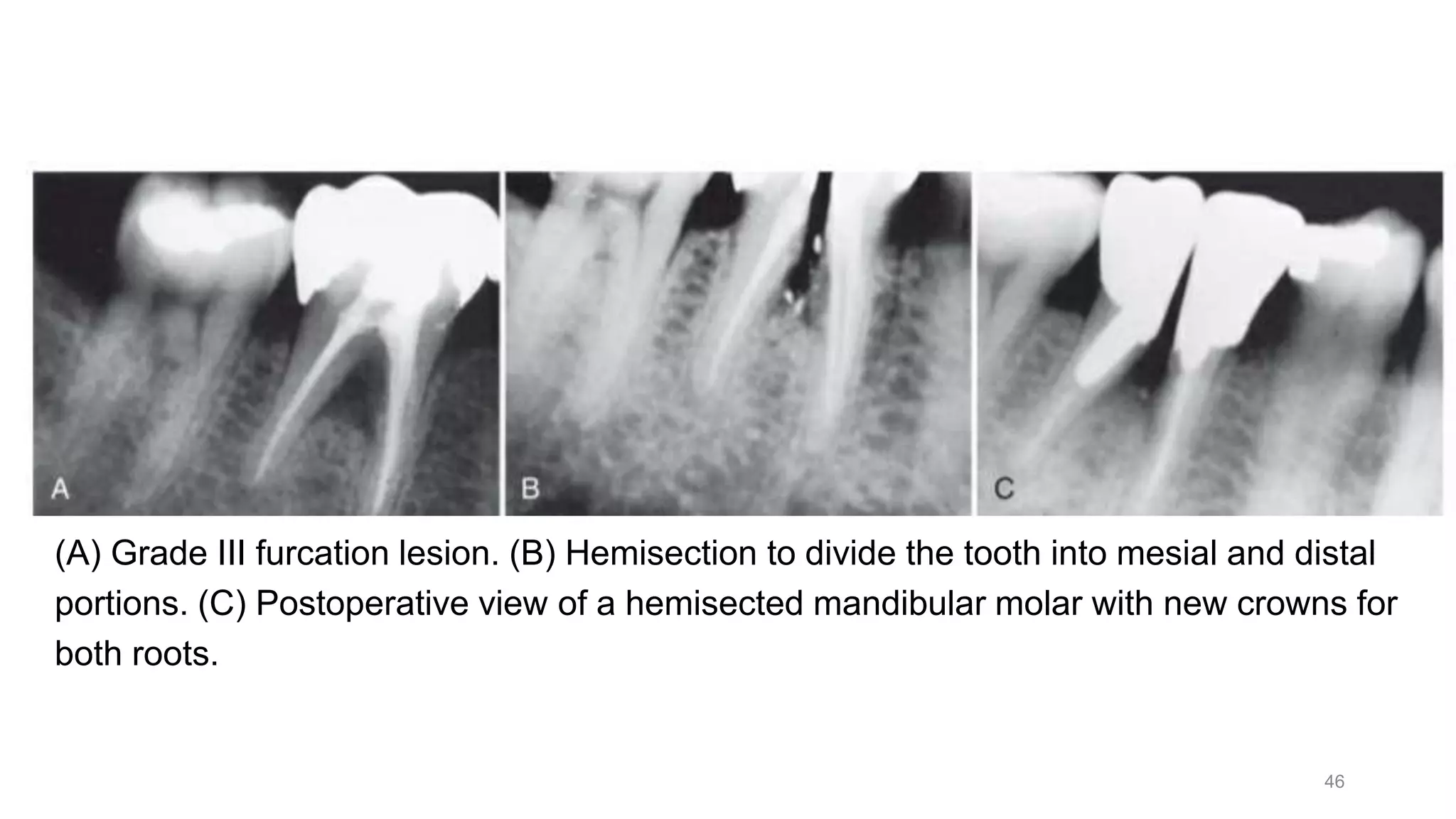 (A) Grade III furcation lesion. (B) Hemisection to divide the tooth into mesial and distal
portions. (C) Postoperative view of a hemisected mandibular molar with new crowns for
both roots.
46
 