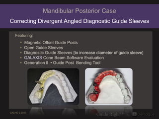Mandibular Posterior Case
Correcting Divergent Angled Diagnostic Guide Sleeves

   Featuring:
        Magnetic Offset Guide Posts
          Open Guide Sleeves
          Diagnostic Guide Sleeves [to increase diameter of guide sleeve]
          GALAXIS Cone Beam Software Evaluation
          Generation ll ▪ Guide Post Bending Tool




CALHO 2.2013
 