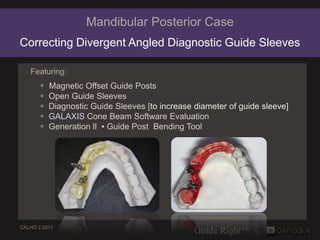 Mandibular Posterior Case
Correcting Divergent Angled Diagnostic Guide Sleeves

   Featuring:
        Magnetic Offset Gui...