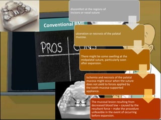 miniscrew supported rme | PPTX