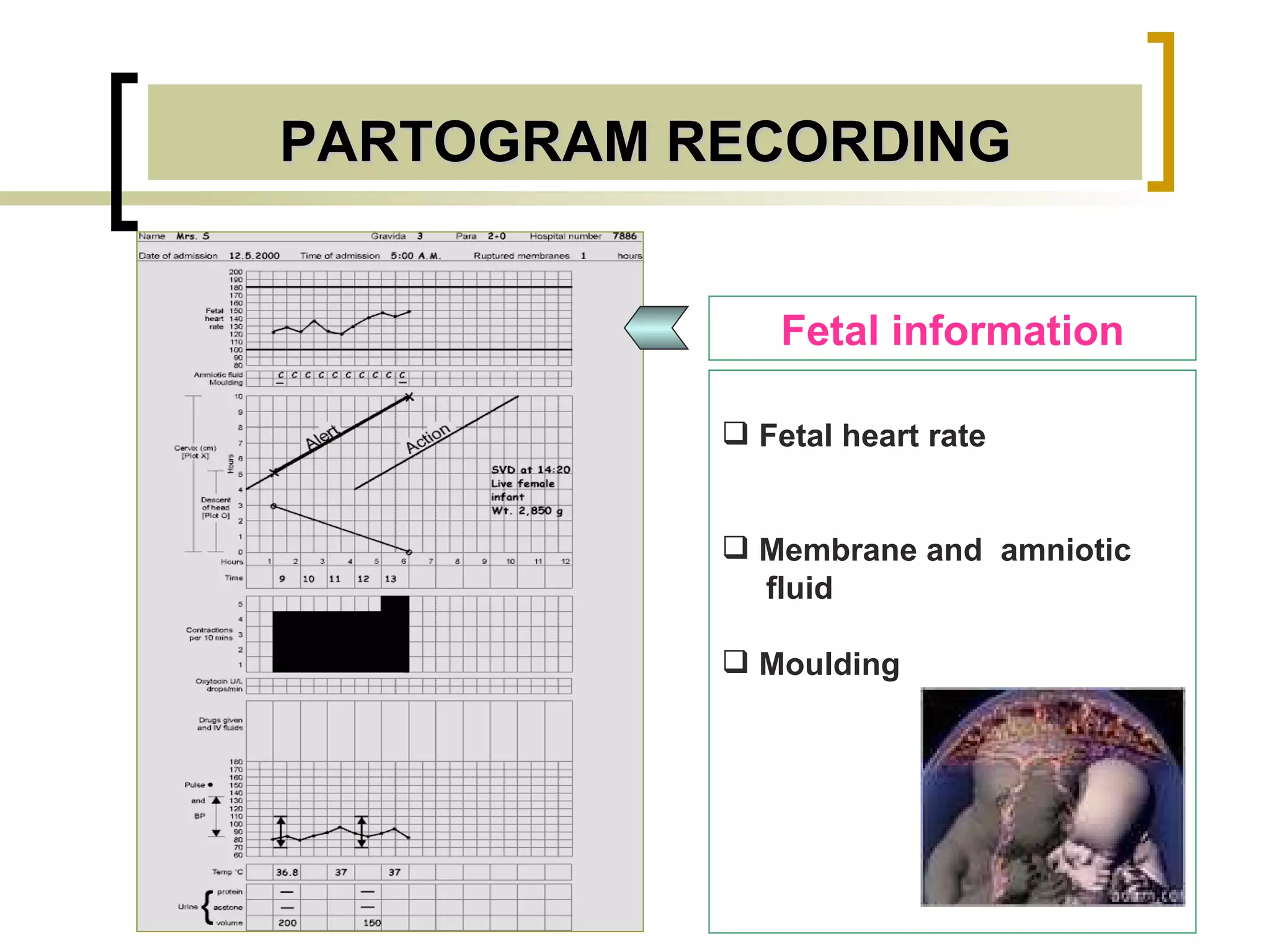 PARTOGRAM RECORDING Fetal information Fetal heart rate Membrane and  amniotic  fluid Moulding 