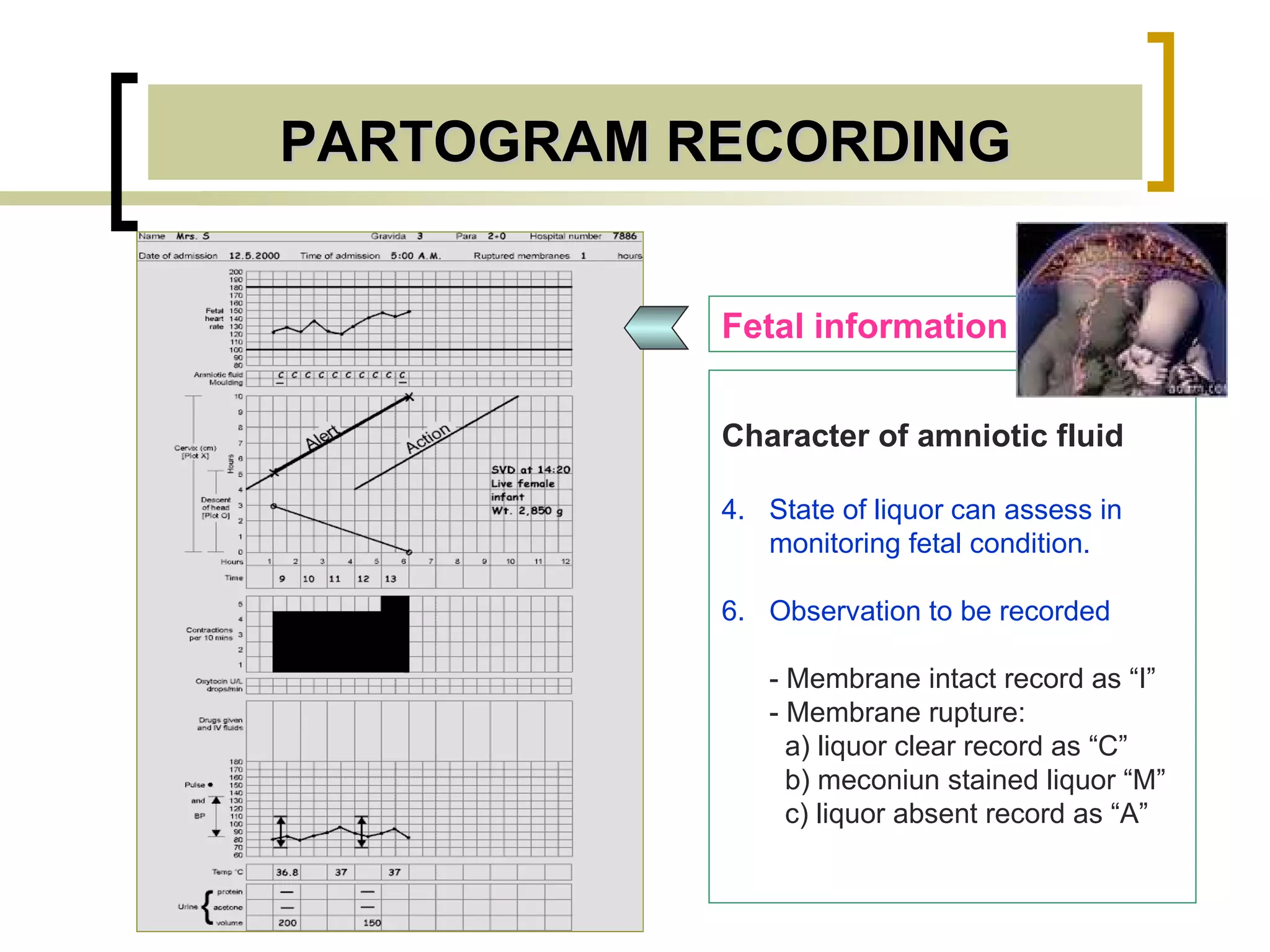 PARTOGRAM RECORDING Fetal information Character of amniotic fluid State of liquor can assess in monitoring fetal condition. Observation to be recorded - Membrane intact record as “I” - Membrane rupture:   a) liquor clear record as “C”   b) meconiun stained liquor “M”   c) liquor absent record as “A”  