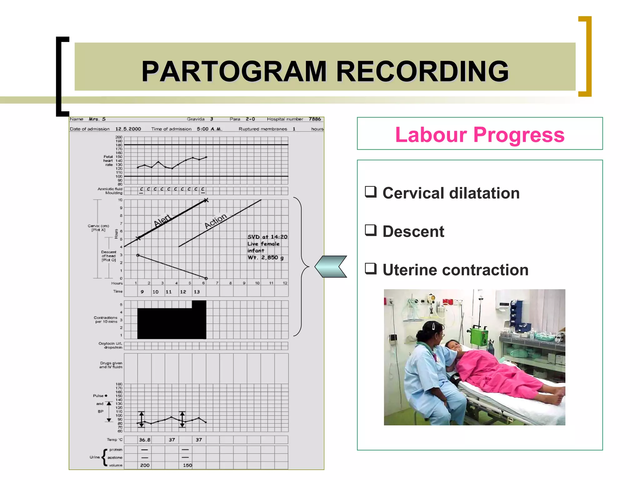 PARTOGRAM RECORDING Labour Progress Cervical dilatation Descent Uterine contraction 