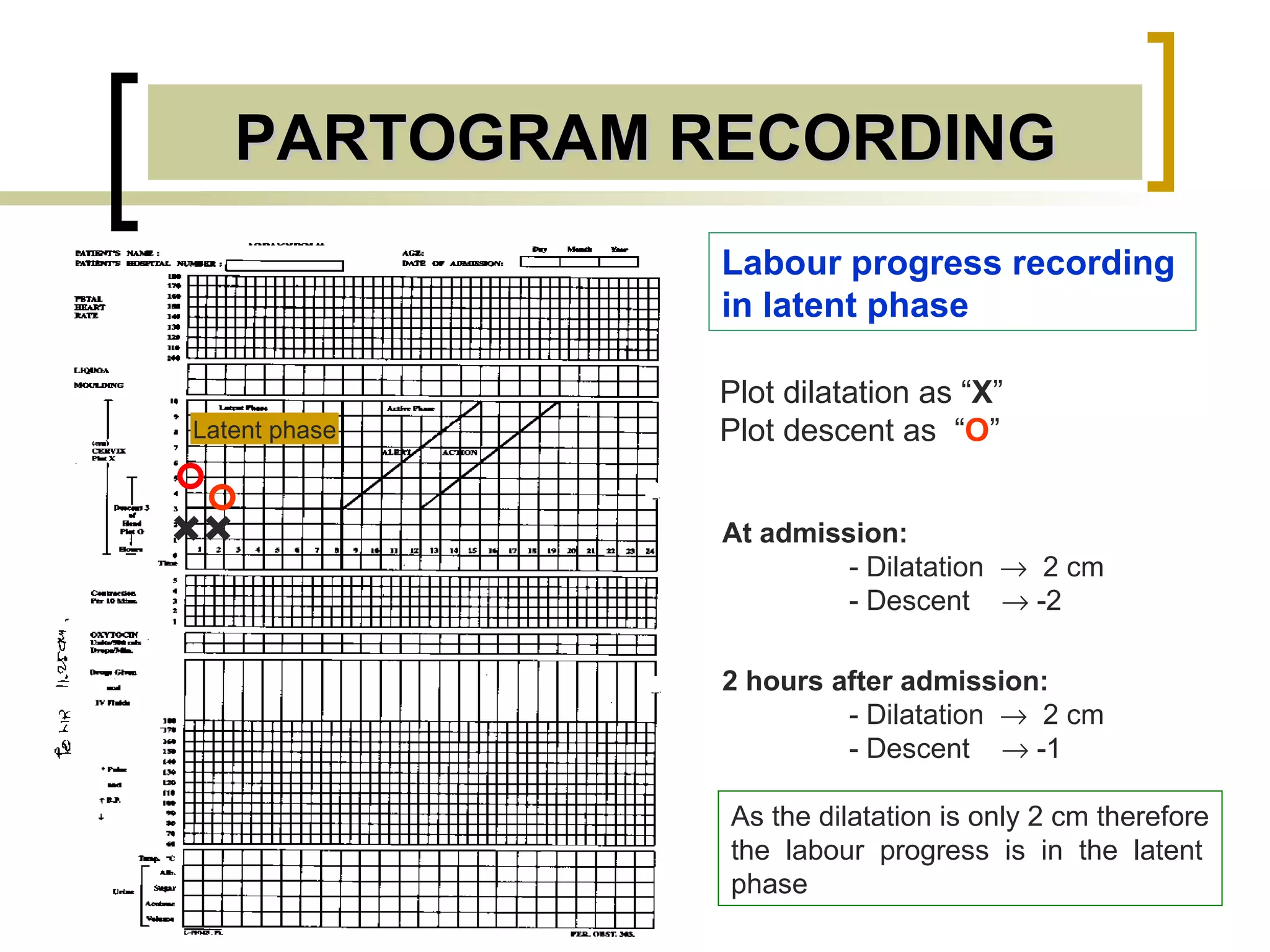PARTOGRAM RECORDING Latent phase Labour progress recording in latent phase At admission: - Dilatation     2 cm - Descent    -2 2 hours after admission: - Dilatation     2 cm - Descent    -1 Plot dilatation as “ X ” Plot descent as  “ O ” + + As the dilatation is only 2 cm therefore the  labour  progress  is  in  the  latent phase  