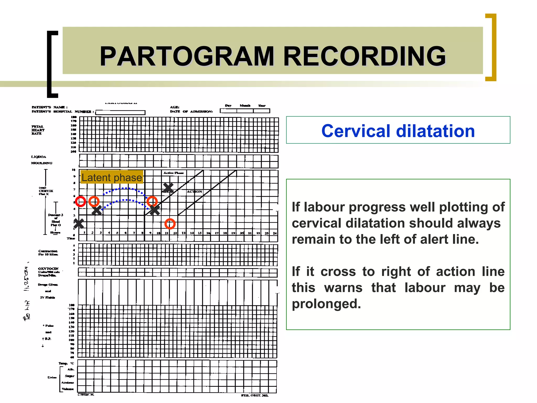 PARTOGRAM RECORDING Latent phase Cervical dilatation + + + + If labour progress well plotting of cervical dilatation should always  remain to the left of alert line. If it cross to right of action line this warns that labour may be prolonged. 