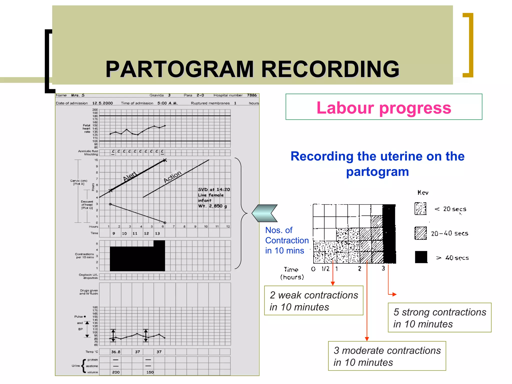 PARTOGRAM RECORDING Labour progress Recording the uterine on the partogram 5 strong contractions in 10 minutes 2 weak contractions in 10 minutes 3 moderate contractions in 10 minutes Nos. of Contraction in 10 mins 