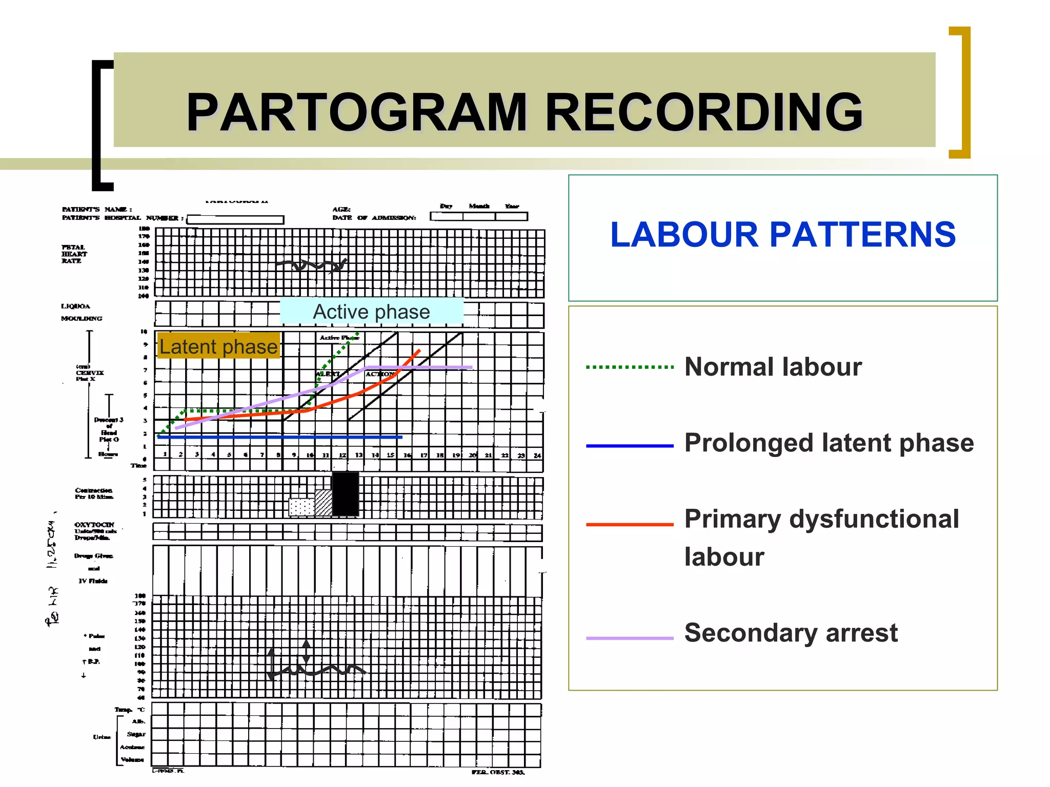 PARTOGRAM RECORDING Latent phase LABOUR PATTERNS Normal labour Prolonged latent phase Primary dysfunctional labour Secondary arrest Active phase 
