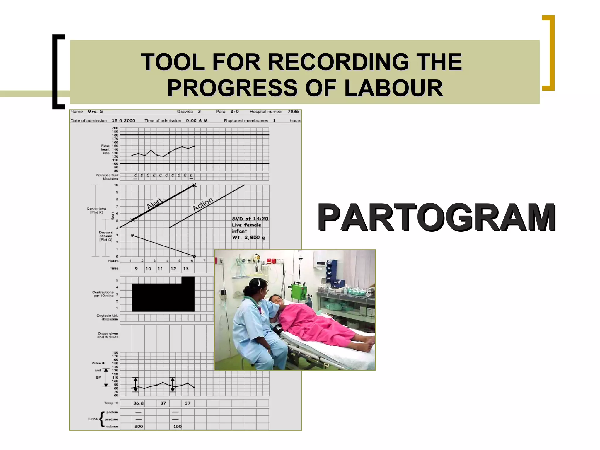 TOOL FOR RECORDING THE  PROGRESS OF LABOUR PARTOGRAM 