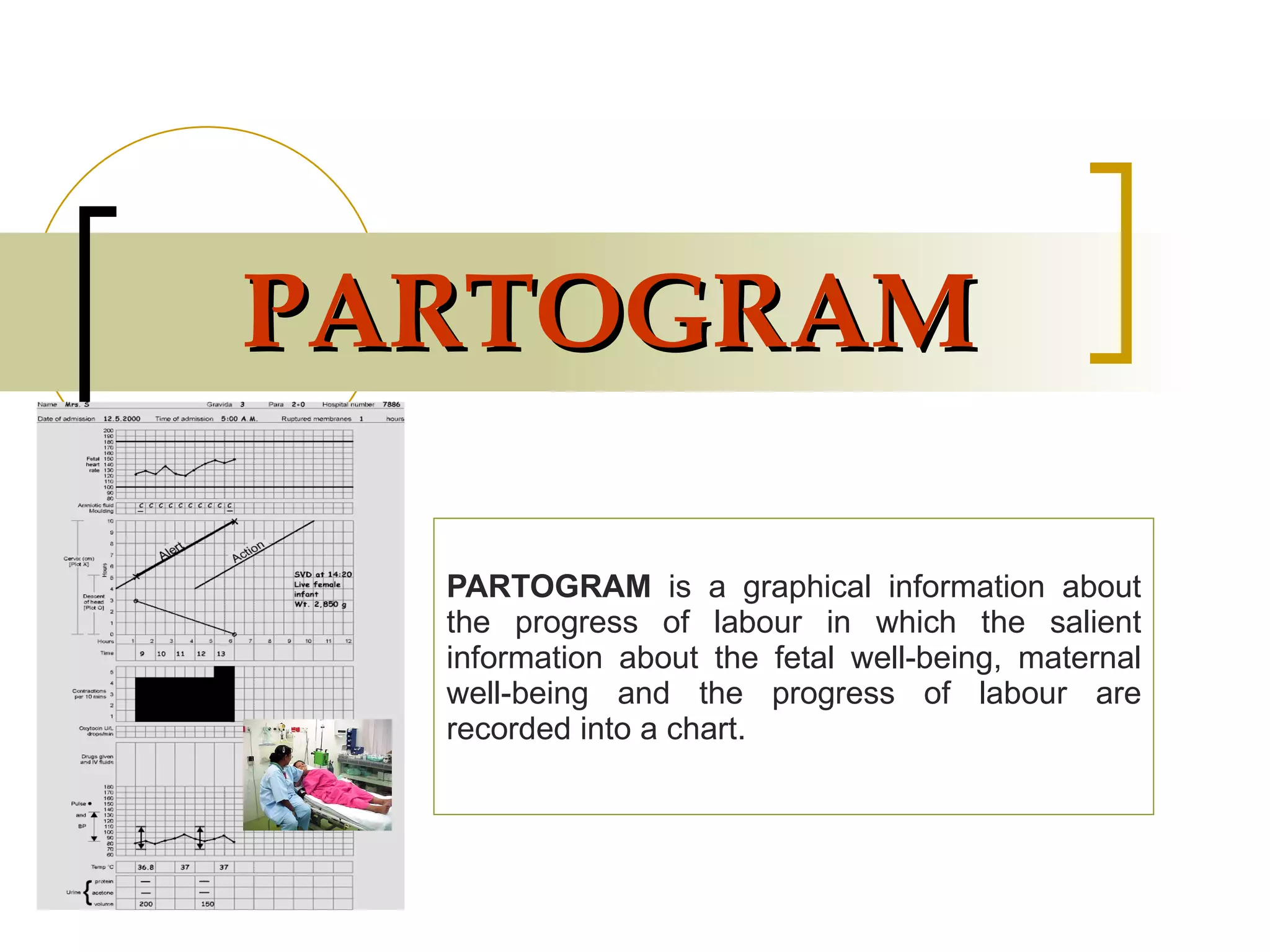 PARTOGRAM PARTOGRAM  is a graphical information about the progress of labour in which the salient information about the fetal well-being, maternal well-being and the progress of labour are recorded into a chart. 