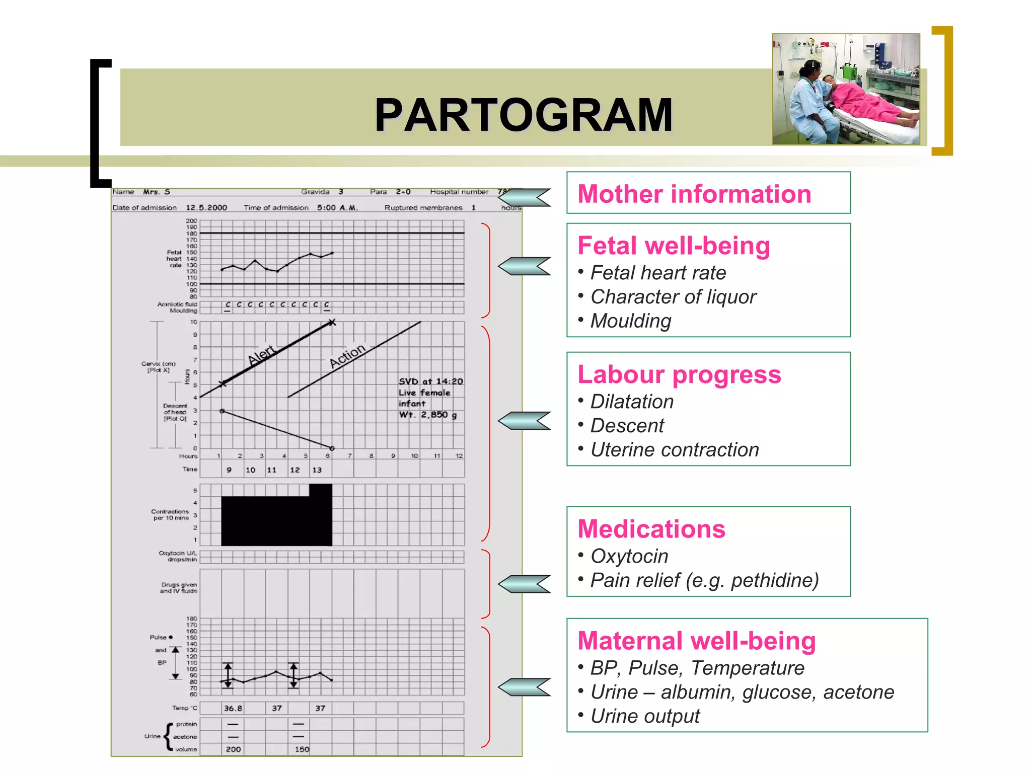 PARTOGRAM Mother information Fetal well-being   Fetal heart rate Character of liquor Moulding Labour progress   Dilatation Descent Uterine contraction Medications Oxytocin Pain relief (e.g. pethidine) Maternal well-being   BP, Pulse, Temperature Urine – albumin, glucose, acetone Urine output 