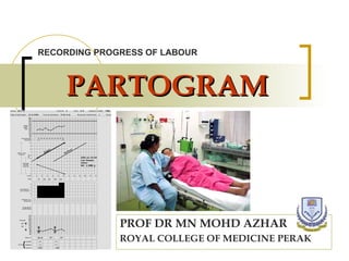 PARTOGRAM PROF DR MN MOHD AZHAR ROYAL COLLEGE OF MEDICINE PERAK RECORDING PROGRESS OF LABOUR 