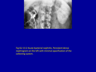 Fig GU 13-2 Acute bacterial nephritis. Persistent dense
nephrogram on the left with minimal opacification of the
collecting system.
 