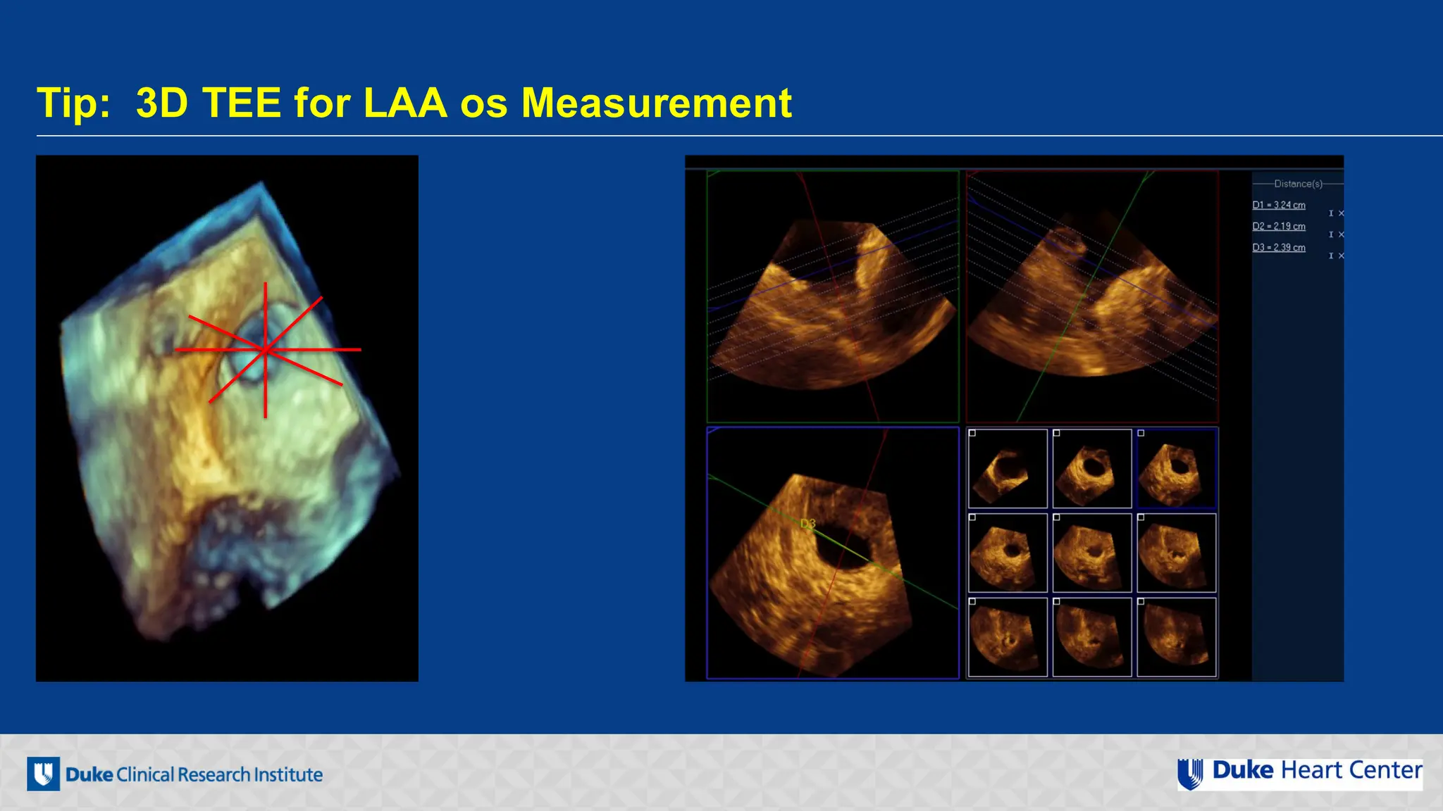 Echocardiography for Structural Heart Disease Interventions | PDF
