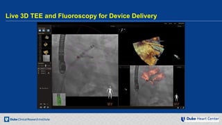 Echocardiography for Structural Heart Disease Interventions | PDF