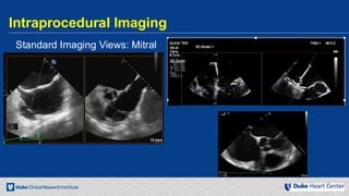 Echocardiography for Structural Heart Disease Interventions | PDF