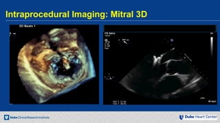 Echocardiography for Structural Heart Disease Interventions | PDF
