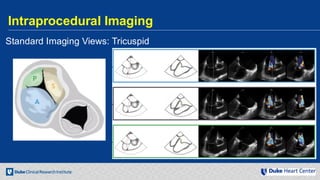 Echocardiography for Structural Heart Disease Interventions | PDF