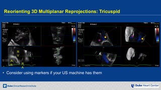 Echocardiography for Structural Heart Disease Interventions | PDF