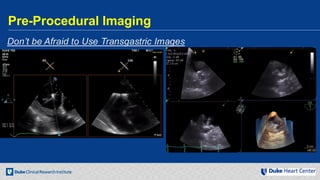 Echocardiography for Structural Heart Disease Interventions | PDF