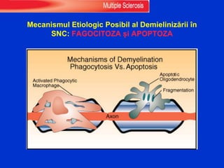 Mecanismul Etiologic Posibil al Demielinizării în
SNC: FAGOCITOZA și APOPTOZA
 