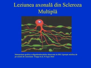Leziunea axonală din Scleroza
Multiplă
Interpretare grafică a oligodendrocitelor observate în SM. Lipseşte mielina de
pe axonii de conexiune Trapp et al, N Engl J Med
 